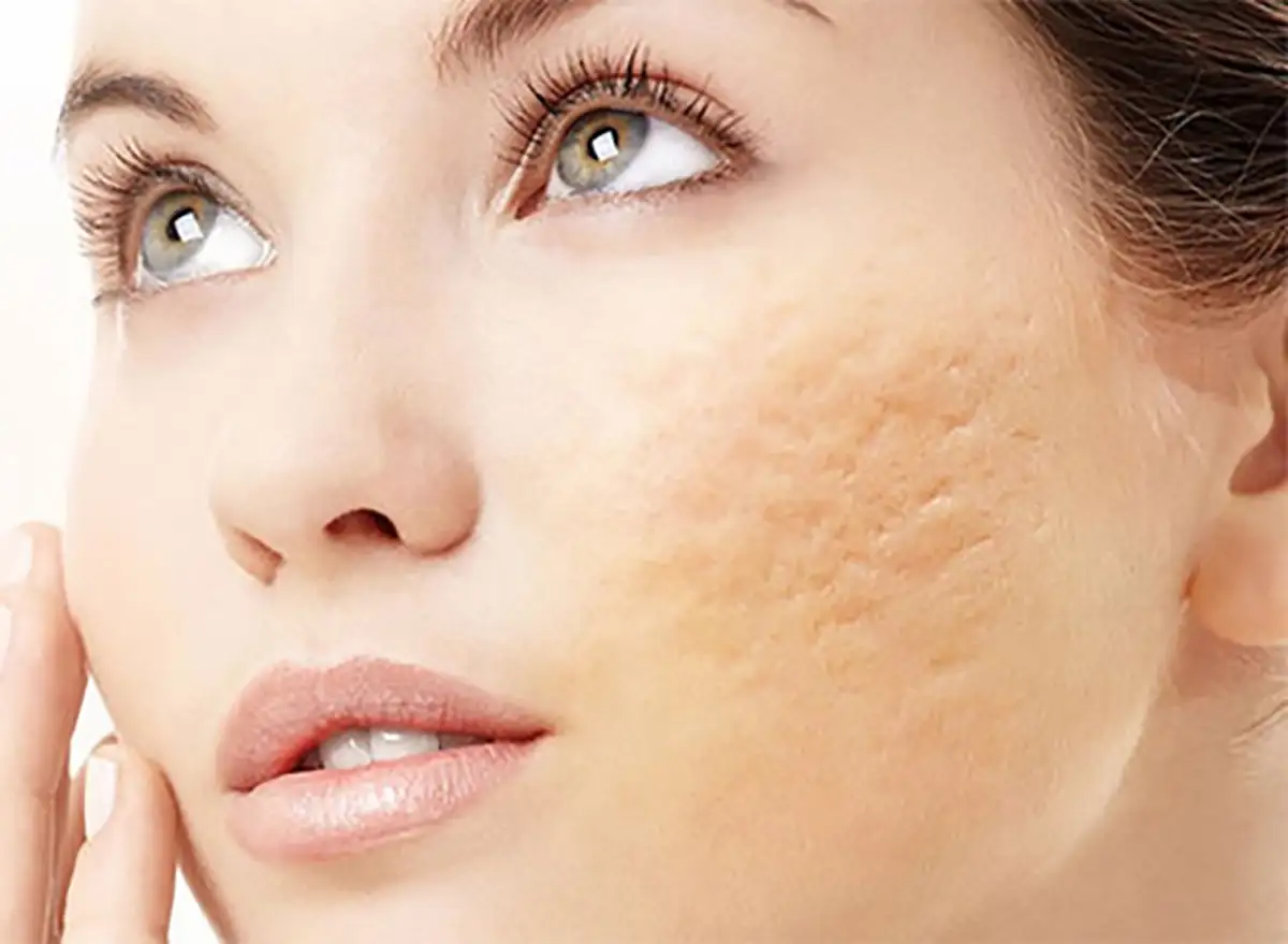 بهترین کرم برای از بین بردن جای جوش نی نی سایت بهترین کرم برای جای جوش و لک صورت بهترین پماد برای جای جوش صورت بهترین کرم ترمیم کننده جای جوش خارجی کرم درمان فرورفتگی جای جوش نی نی سایت کرم برای از بین بردن جای جوش با قیمت کرم از بین بردن لکه های قهوه ای جای جوش پماد آلفا برای جای جوش نی نی سایت