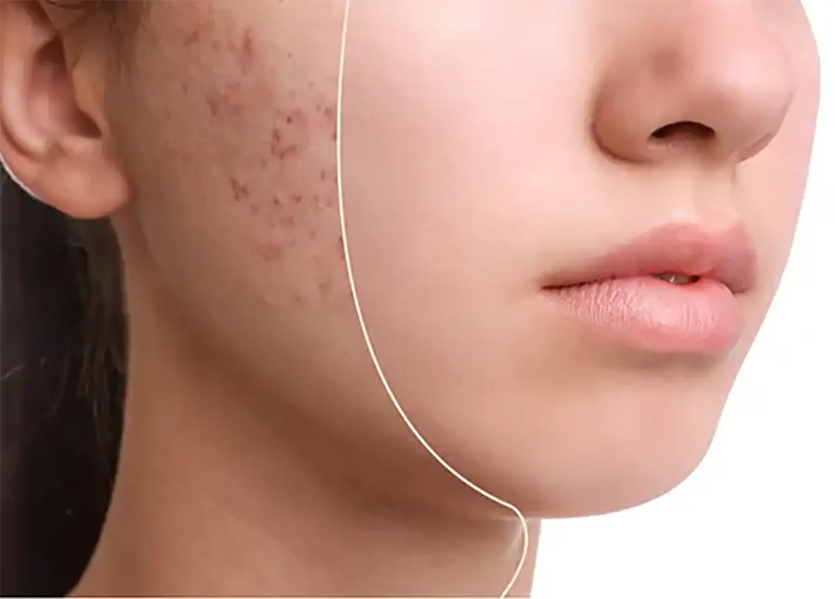 بهترین کرم برای گودی جای جوش | راهنمای کامل و معرفی محصولات موثر
