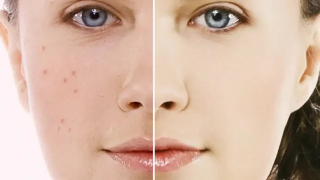 بهترین زمان حجامت برای جوش صورت | جوش‌های صورت و راز حجامت چیست؟