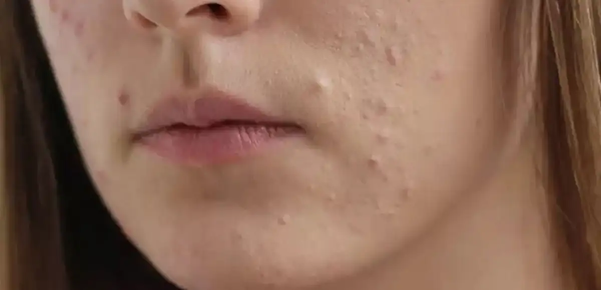 بهترین سرم ضد جوش نی نی سایت بهترین سرم ضد جوش برای پوست چرب بهترین سرم صورت خارجی بهترین سرم ضد جوش و لک بهترین سرم جوانسازی پوست بهترین سرم آبرسان پوست چرب سرم ضد جوش قوی بهترین سرم ضد جوش ایرانی