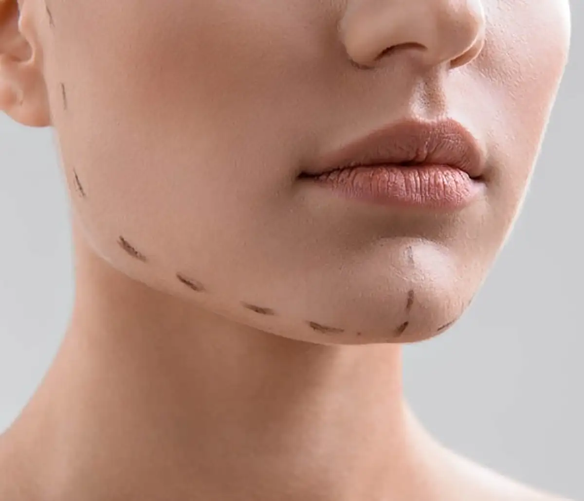 بهترین ژل برای تزریق چانه | کدوم برند رو بخریم؟